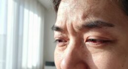 bright light causes eye discomfort